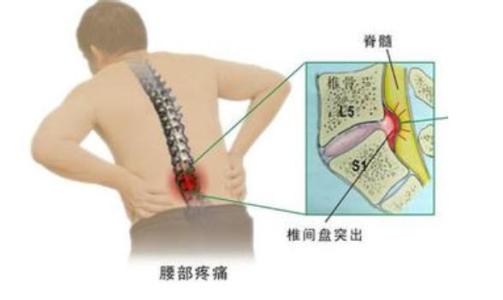 椎间盘突出