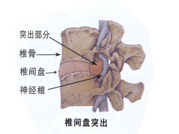 椎间盘突出